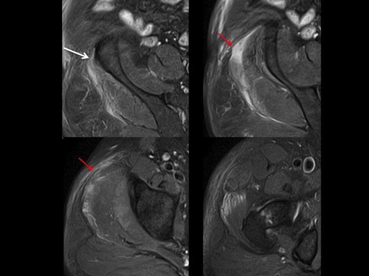 Figure 3 for case iliotibial band ( RID2855 )